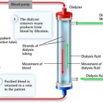 Hemodialysis Process