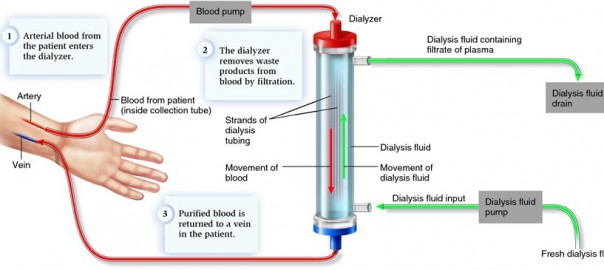 Hemodialysis Process