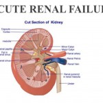 Acute Renal Failure Causes and Symptoms